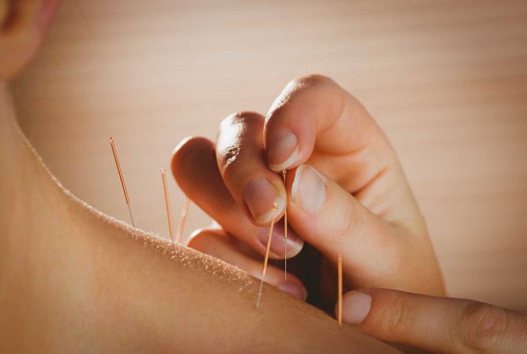 châm cứu điều trị bệnh trầm cảm