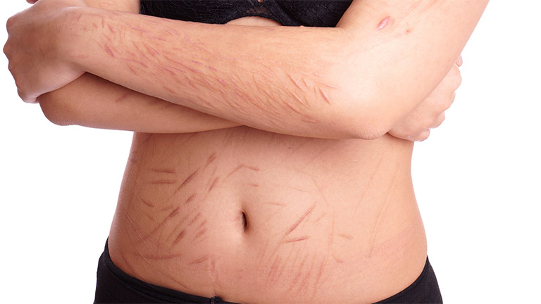 Hội chứng tự ngược đãi bản thân tiếng Anh hội chứng Self - harm nguy hiểm không