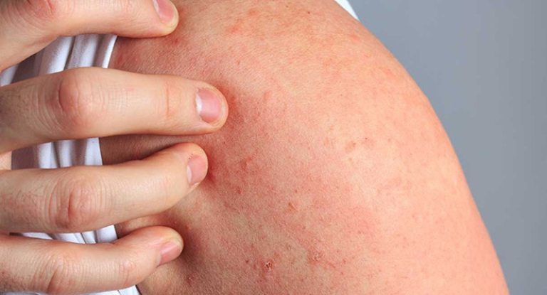 nổi mề đay do stress nặng