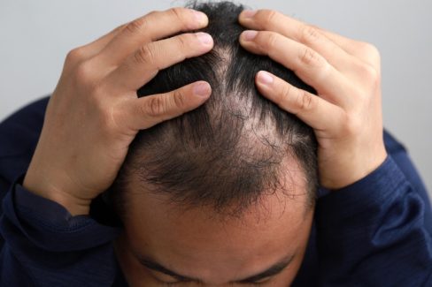 stress có thể gây rụng tóc