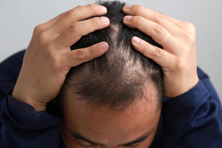 stress có thể gây rụng tóc