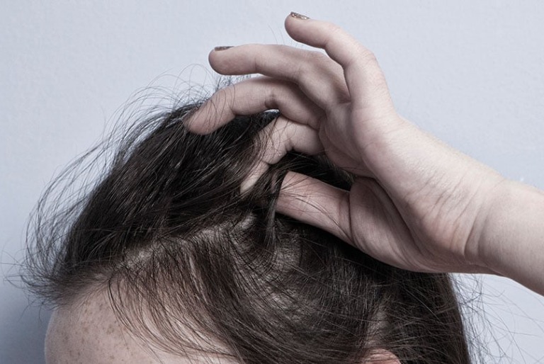 Rụng tóc do stress