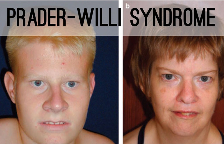 Prader-Willi Syndrome là gì Prader-Willi Syndrome là gì