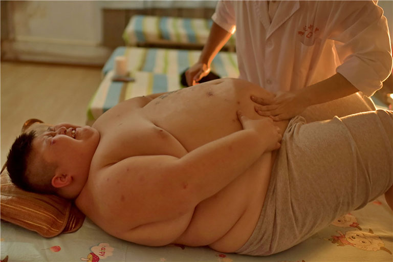 hội chứng prader-willi hội chứng prader-willi