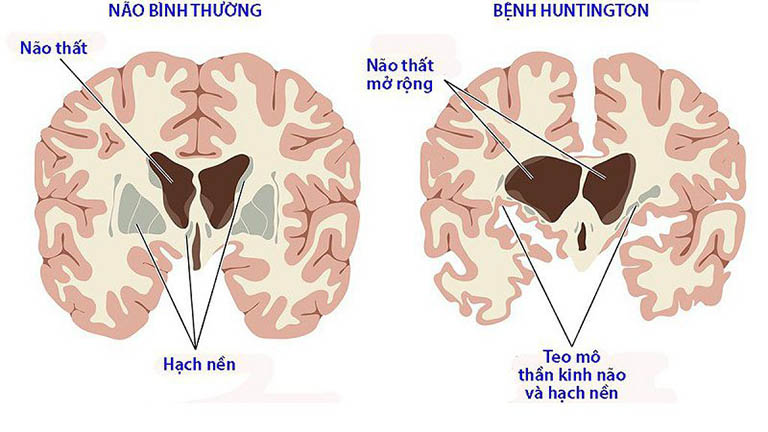 Bệnh Huntington