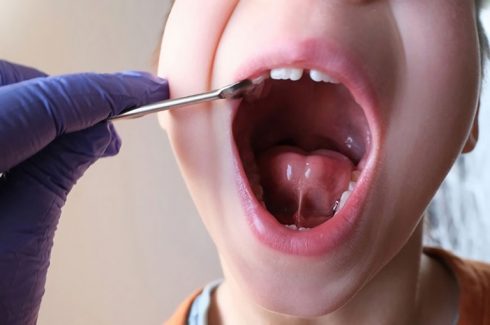 Trẻ bị dính thắng lưỡi chậm nói