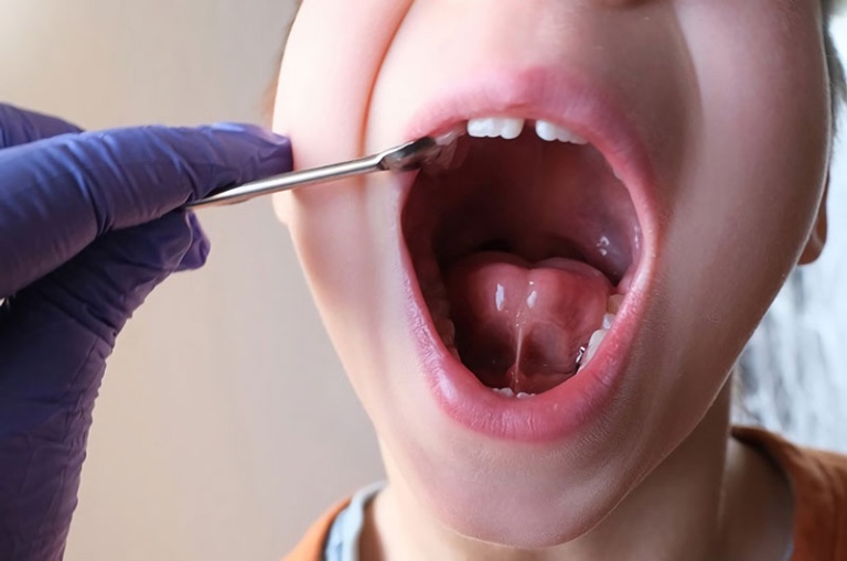 Trẻ bị dính thắng lưỡi chậm nói