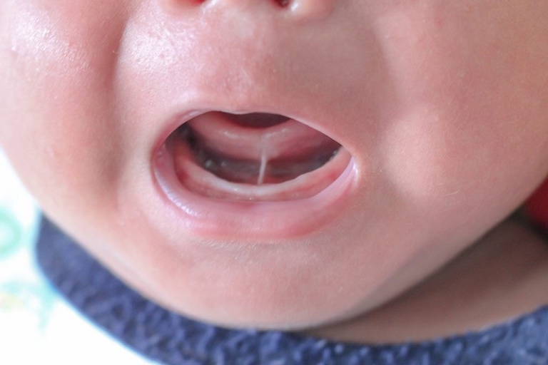 Trẻ bị dính thắng lưỡi chậm nói