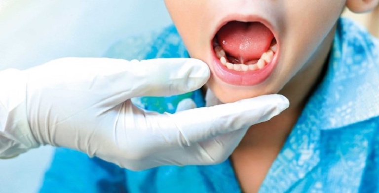 Trẻ bị dính thắng lưỡi chậm nói
