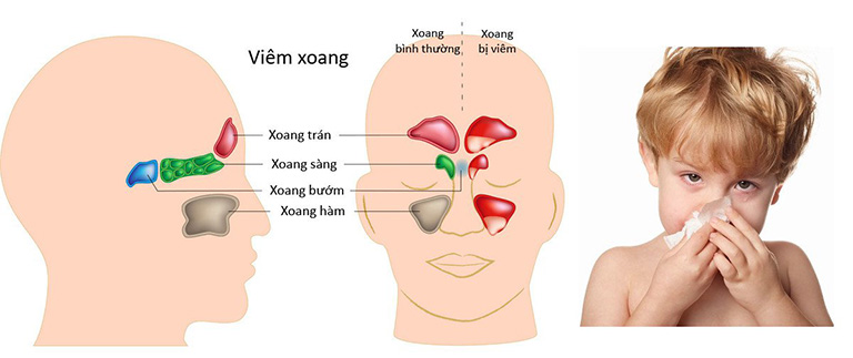 Trẻ nói ngọng