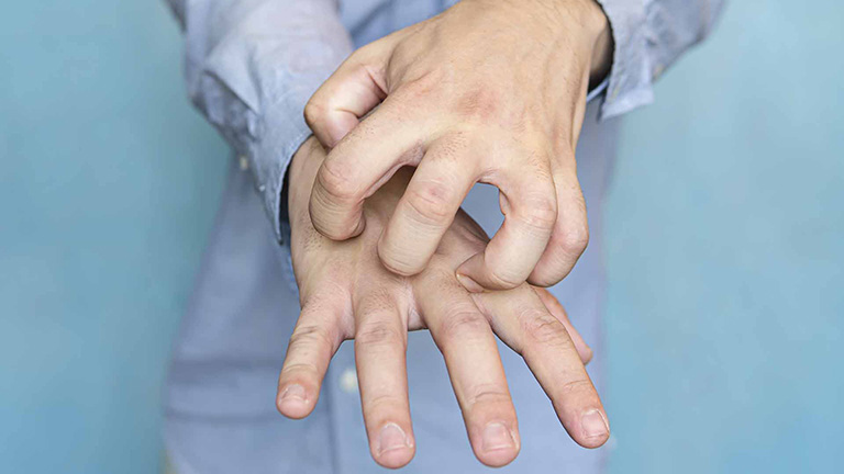 Hội chứng mê sảng ký sinh trùng