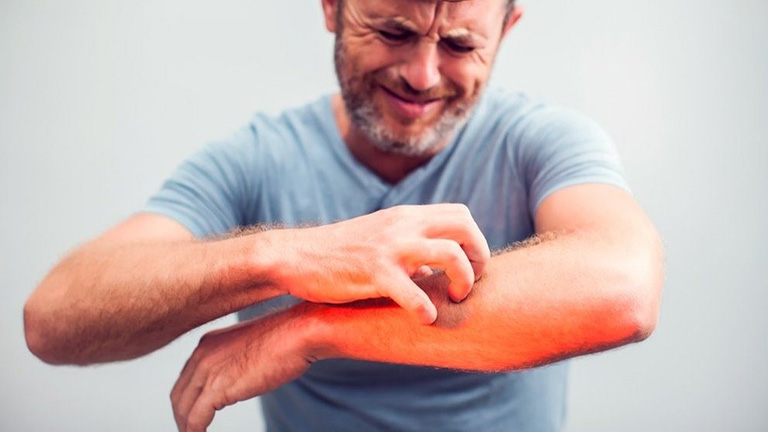 Hội chứng mê sảng ký sinh trùng
