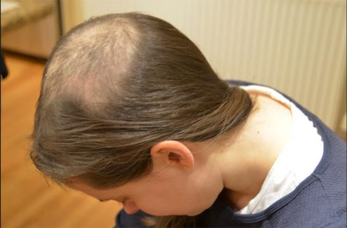 Hội chứng nghiện nhổ tóc