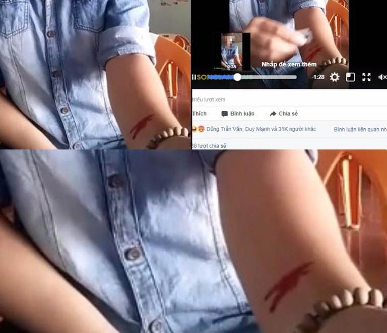 người trẻ rạch tay do trầm cảm