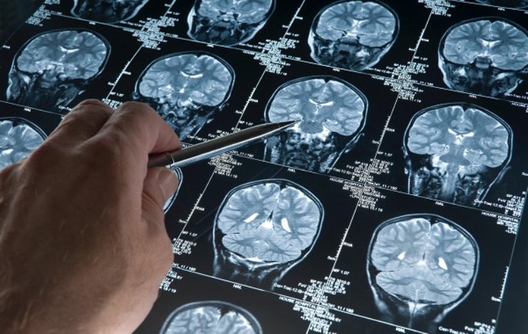 Chụp MR chẩn đoán mê sảng